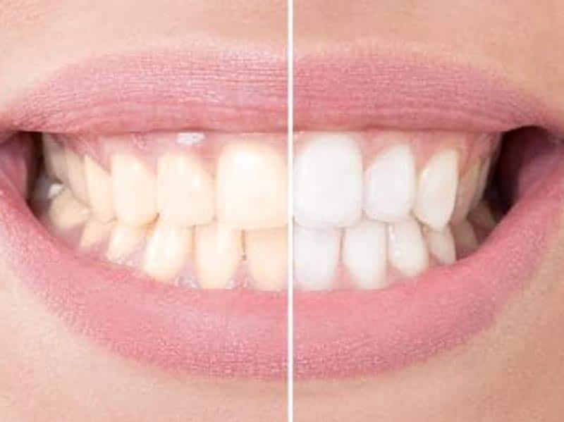 cosmetic-whitening