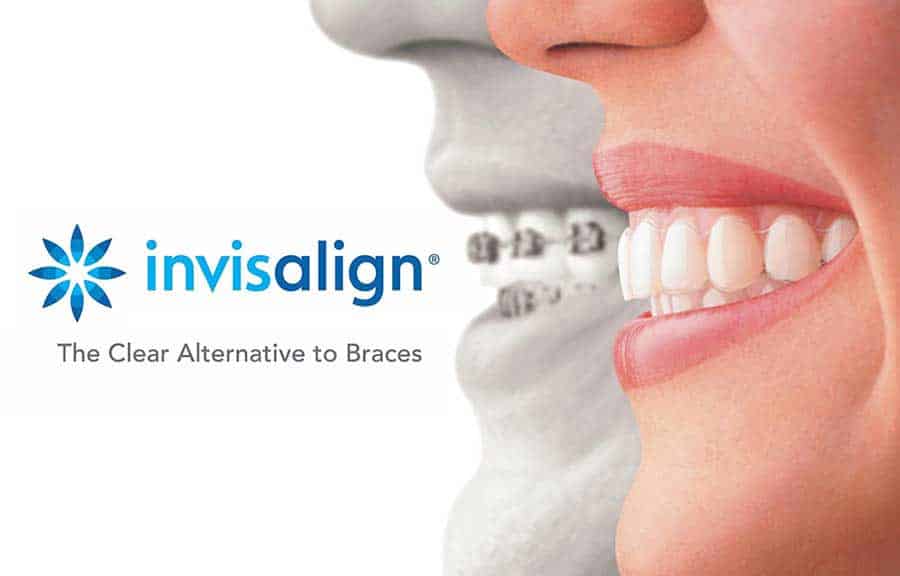 invisalign